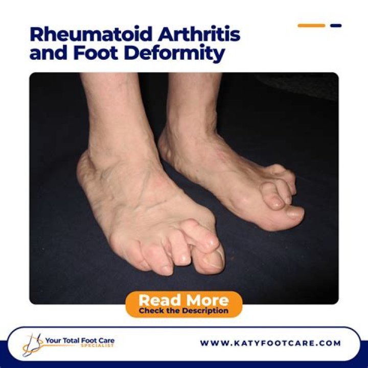 Can I lift weights with rheumatoid arthritis?