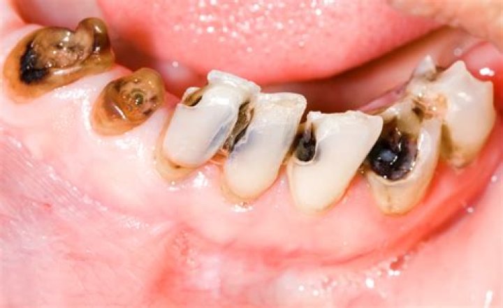 Can stress cause tooth decay?