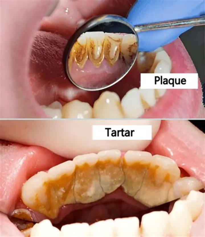 Can turmeric remove tartar?