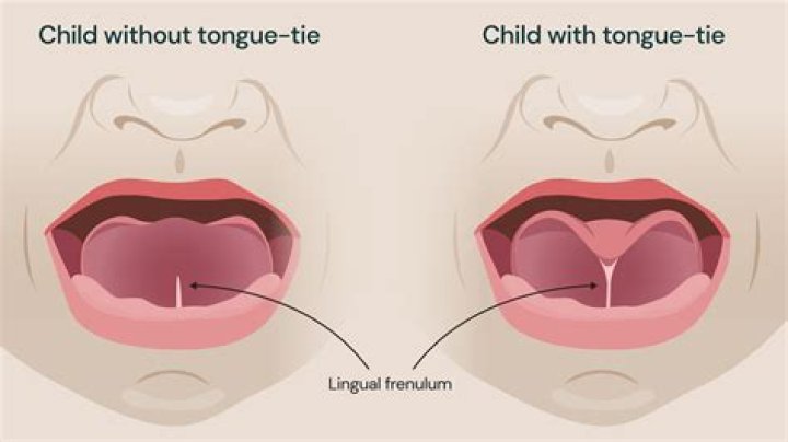 Can we talk without a tongue?