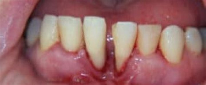 Can you fix severe periodontal disease?