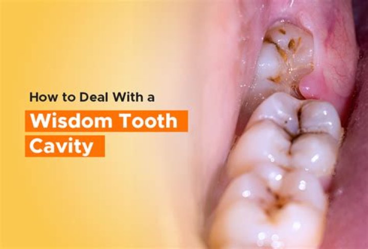 Can you get your wisdom teeth at 35?