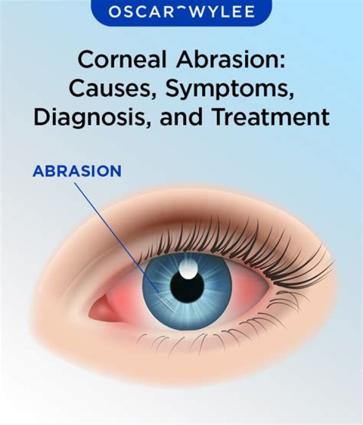Can you watch TV with a corneal abrasion?