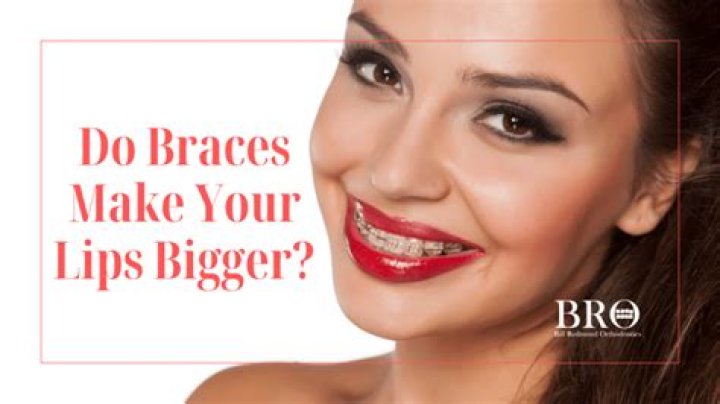 Do braces make teeth look bigger?