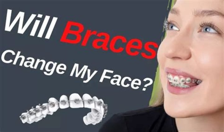 Do braces reshape your face?