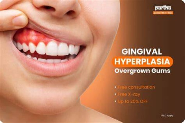 Do overgrown gums go away?