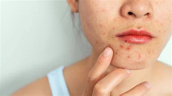 Do tears clear acne?