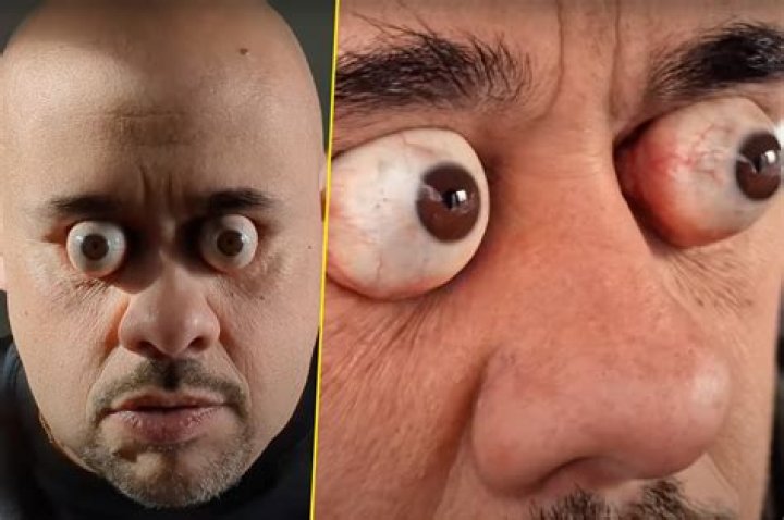 Has anyones eye popped out from sneezing?