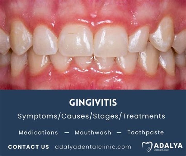 How can I get rid of gingivitis fast?