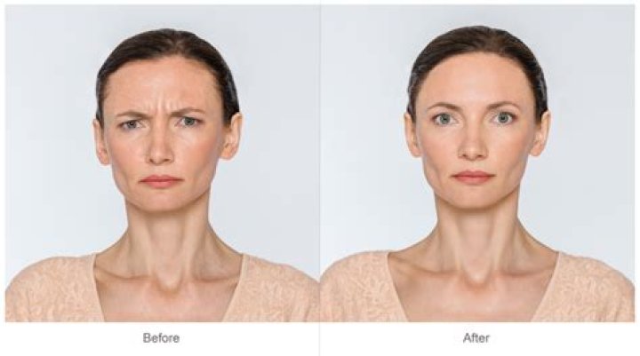 How can you tell if someone has had Botox?