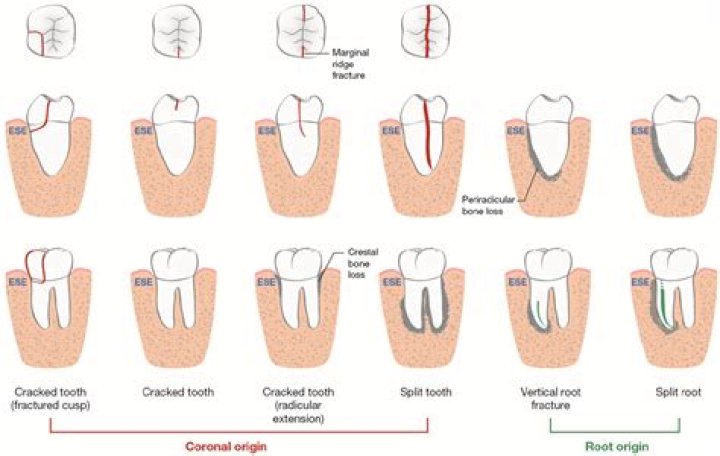 How common are shovel teeth?
