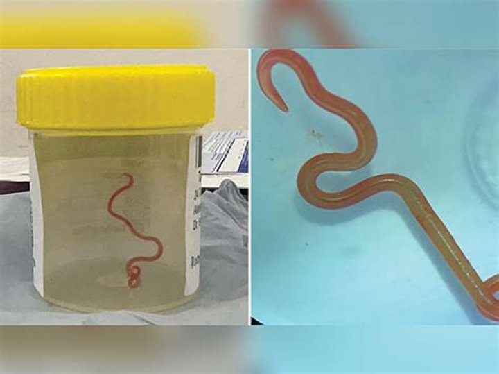 How do doctors test for worms in humans?
