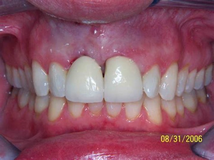 How do I make my gums grow back?