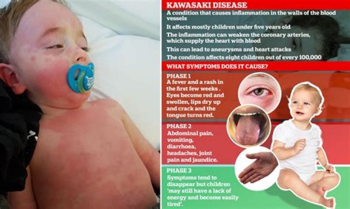 How do you get Kawasaki disease?