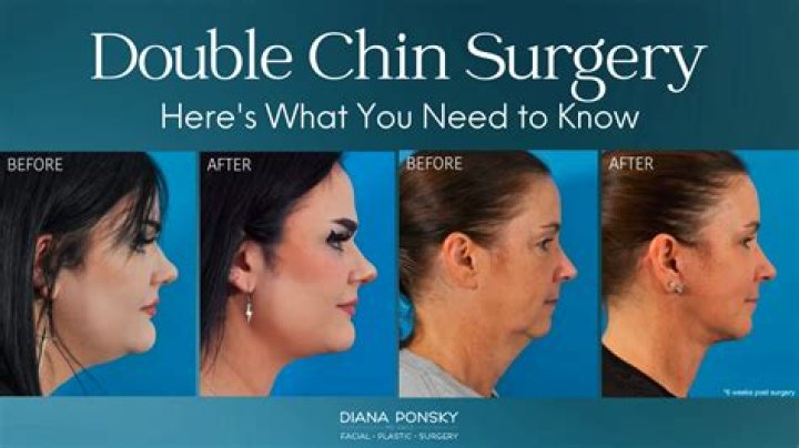 How do you get rid of a double chin in a week?
