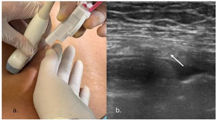How do you prepare for a lung needle biopsy?