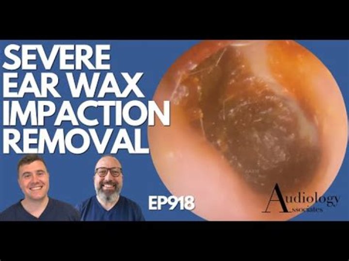 How do you remove hard impacted ear wax?