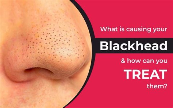 How long can blackheads last?
