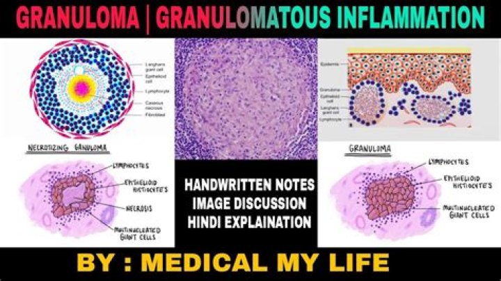 How long can you live with granulomatous disease?