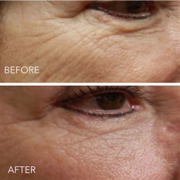 How long does it take for collagen to form after microneedling?
