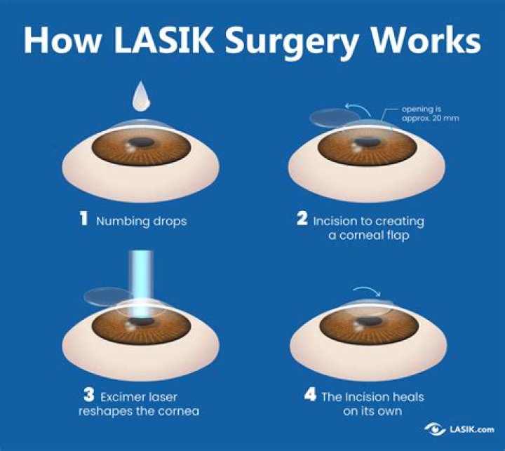 How long does it take for LASIK to stabilize?