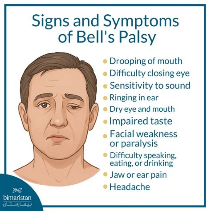 How long does the pain last with Bell's palsy?