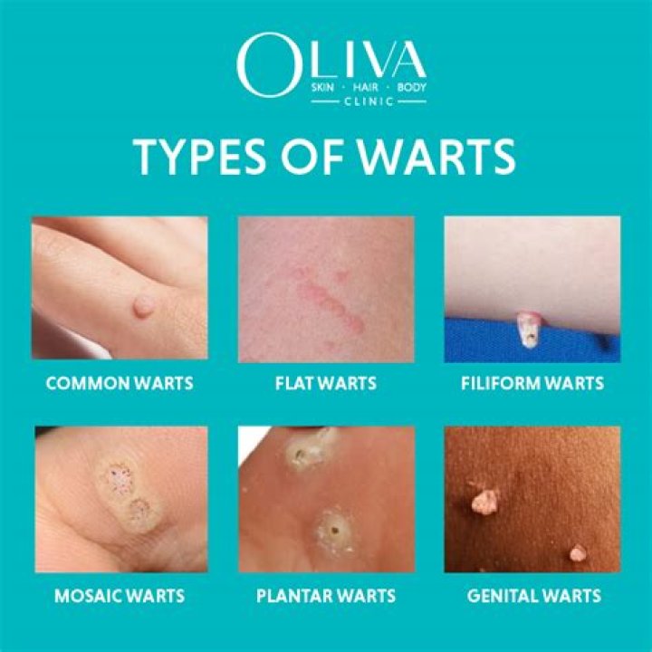 How long does wart virus live on dry surfaces?
