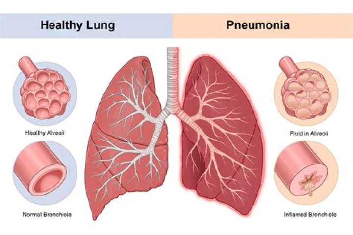 How many pneumonia shots do you need?