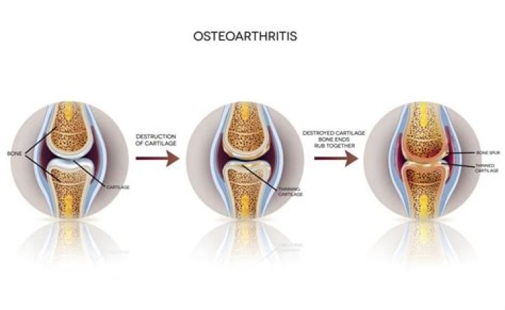 How many stages of osteoarthritis are there?