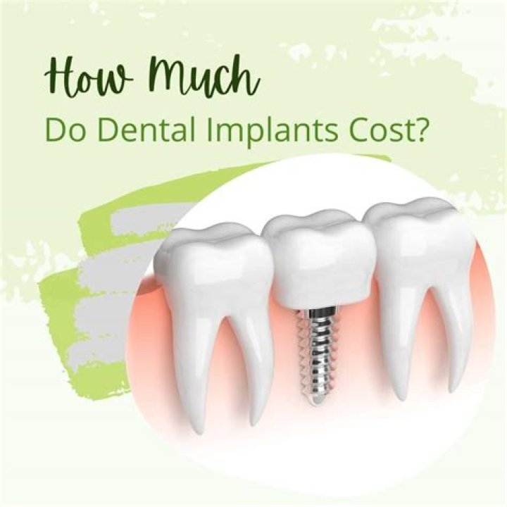 How much do implants cost?