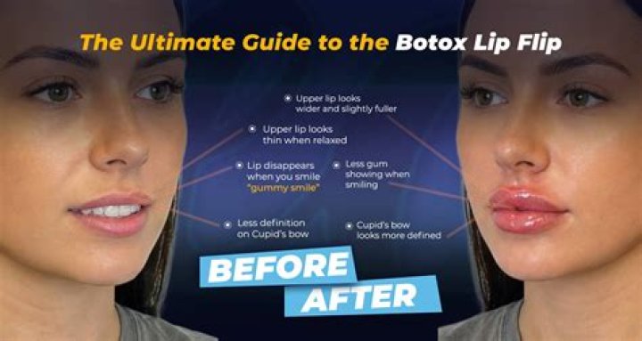 How often can you get a lip flip with Botox?