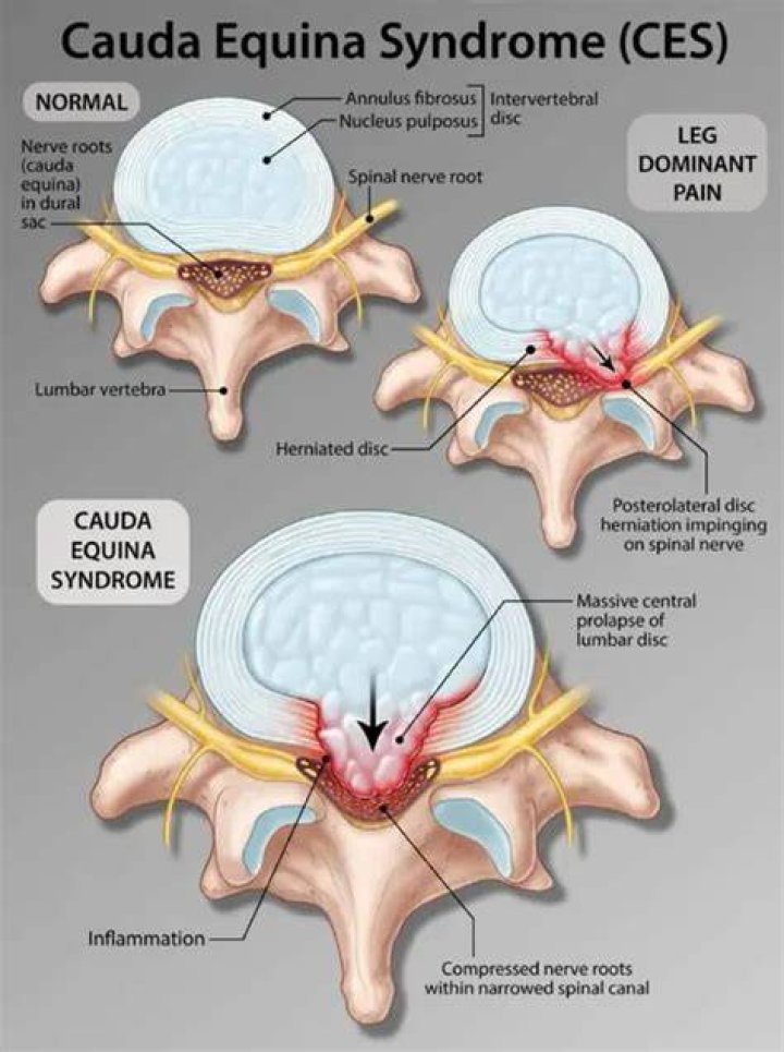 How painful is cauda equina syndrome?