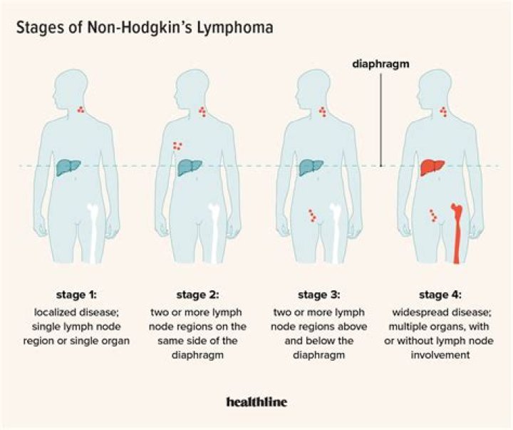 How serious is non-Hodgkin's lymphoma?