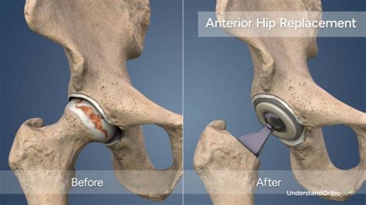 How soon after hip replacement can I shower?