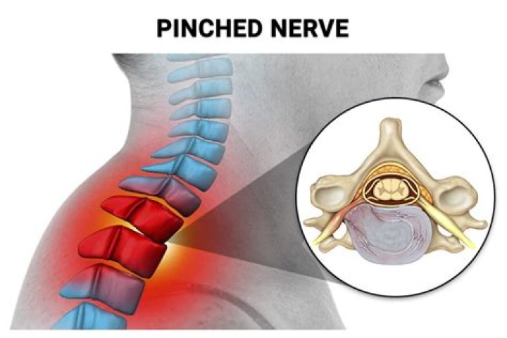 Is a pinched nerve serious?