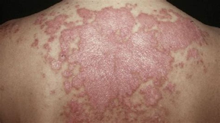 Is it hard to walk with lupus?