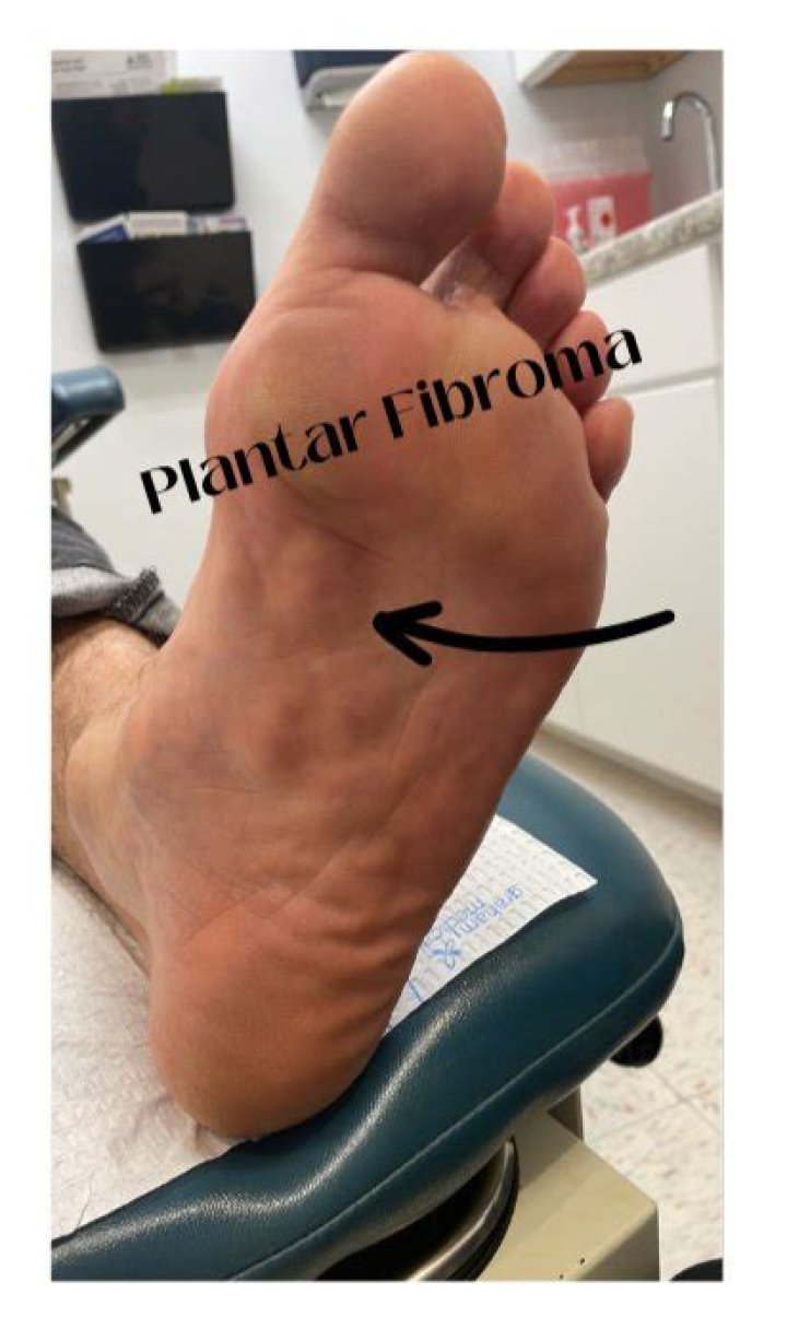 Is plantar fibromatosis the same as plantar fasciitis?