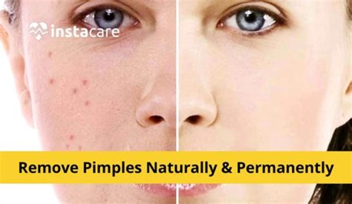 Is sleeping early can remove pimples?