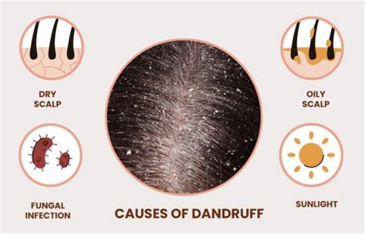 Should I comb out my dandruff?