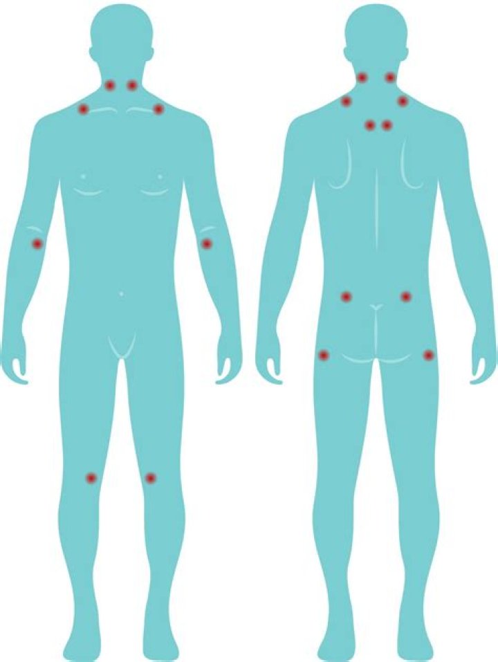 What are the 11 tender points of fibromyalgia?