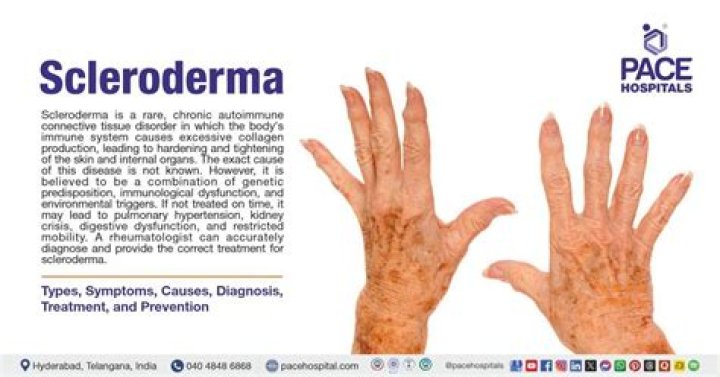 What are the symptoms of limited scleroderma?