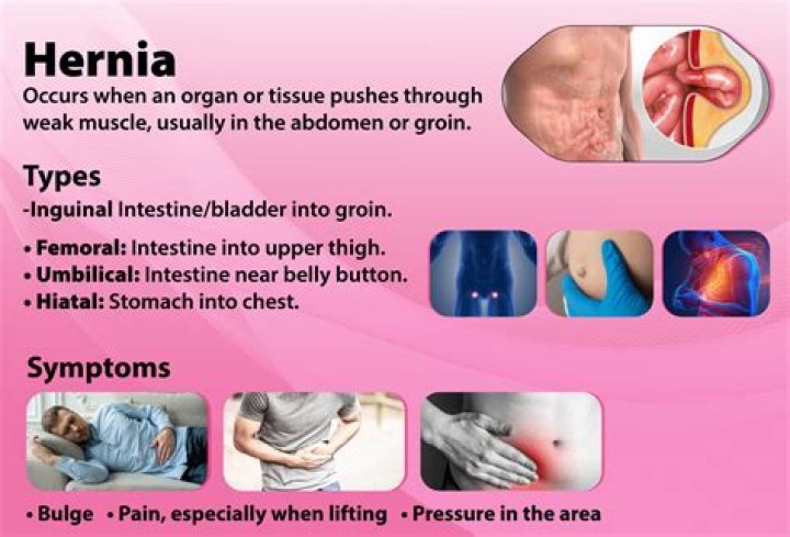 What can be mistaken for a groin hernia?