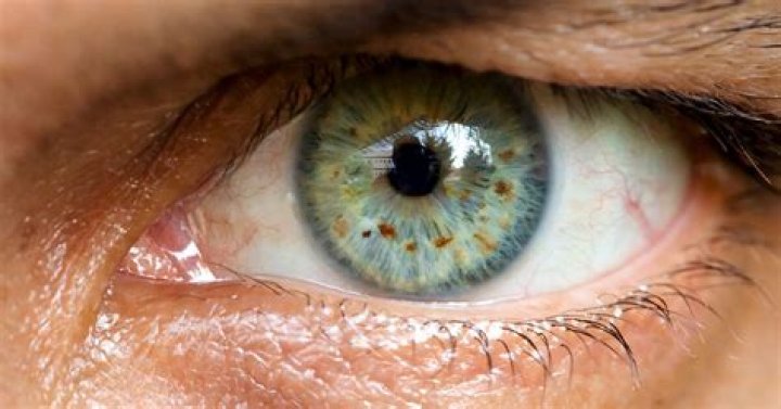 What causes brown spots on white of eyes?