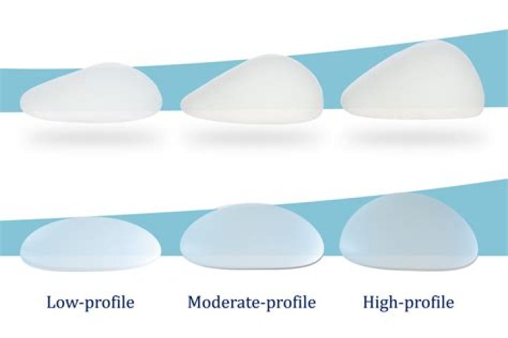 What does bottomed out implants look like?
