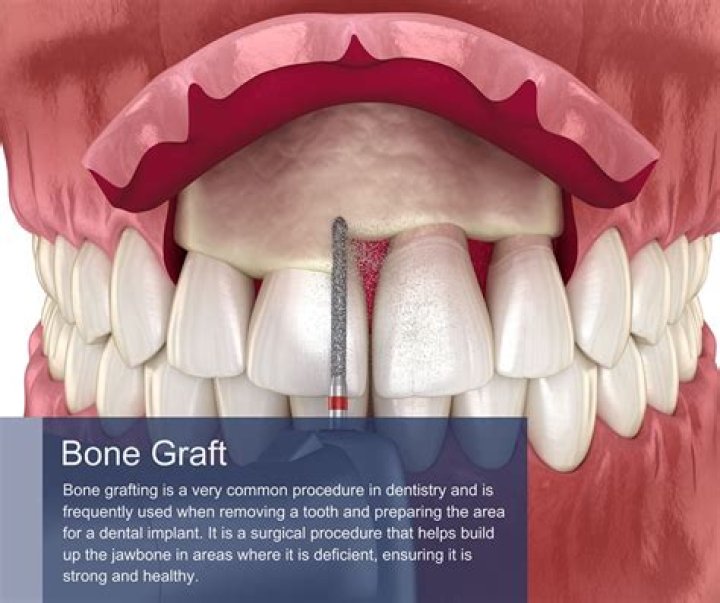 What happens if I don't get a bone graft after tooth extraction?