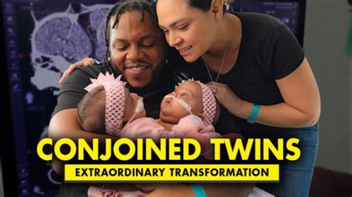 What happens if one of the conjoined twins dies?
