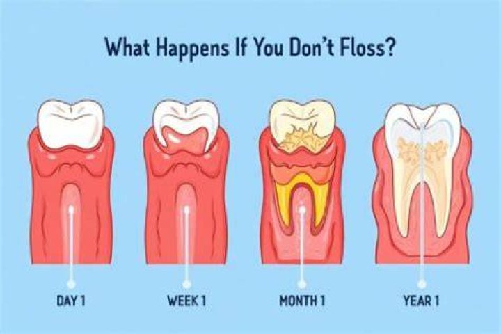 What happens if you don't floss?