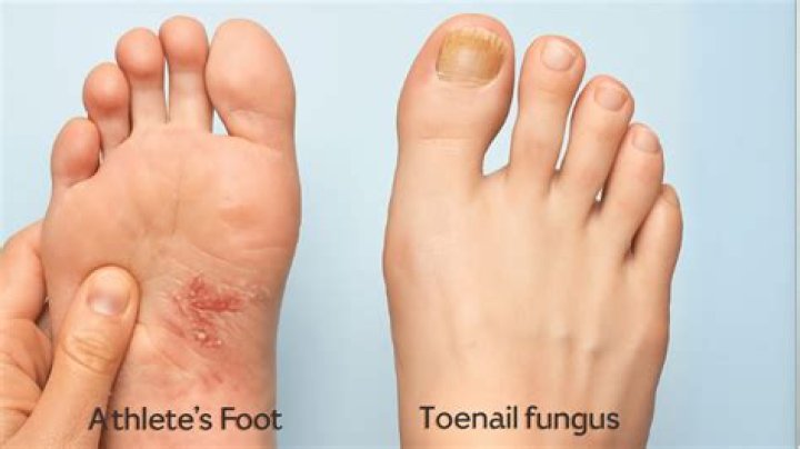 What happens if you touch toe fungus?