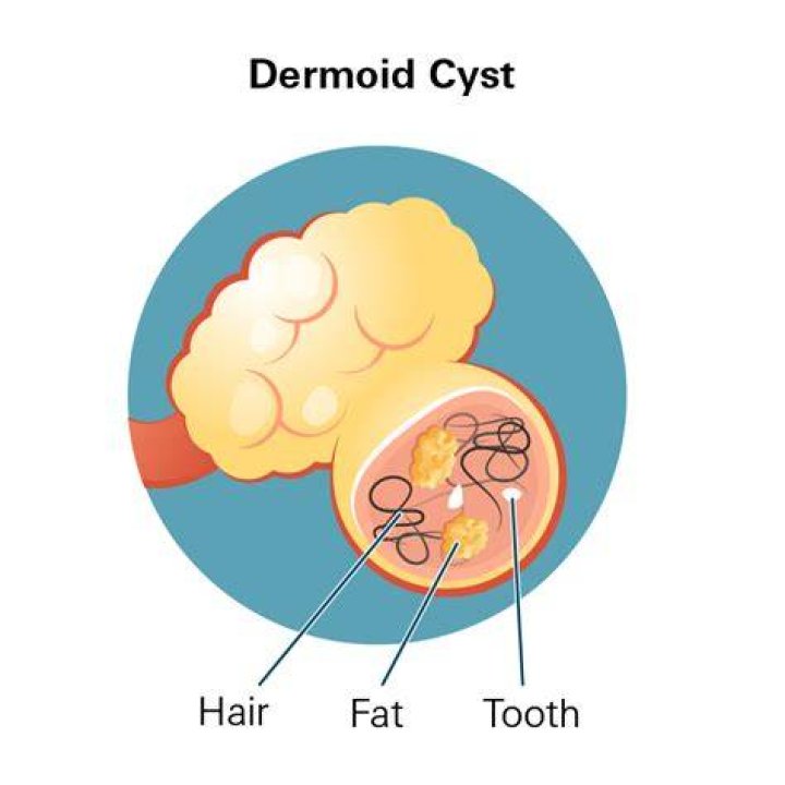 What is another name for dermoid cyst?
