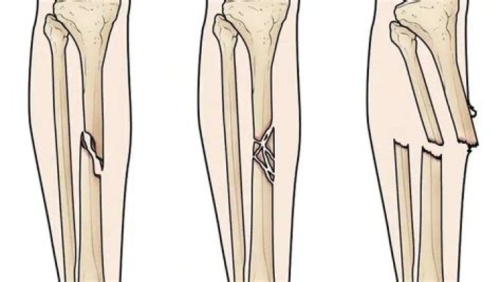 What is butterfly fracture?